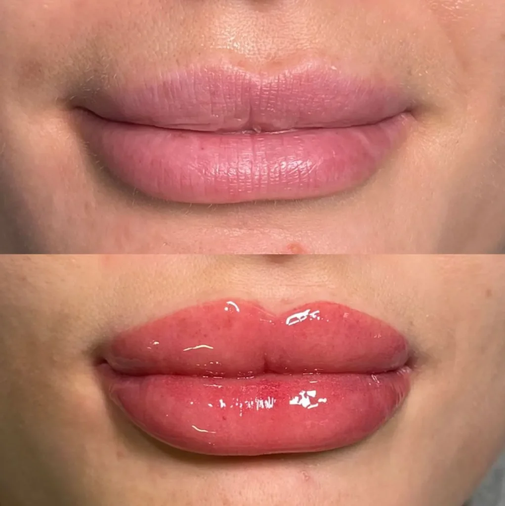 What Are the Disadvantages of Cosmetic Tattooing