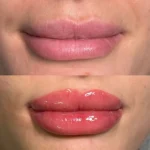 What Are the Disadvantages of Cosmetic Tattooing