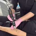 Why do I feel sick after tattoo removal